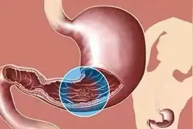 十二指肠溃疡你真的完全了解？图片