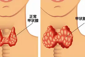 甲状腺结节会发生癌变吗？在饮食方面应该注意哪些？图片