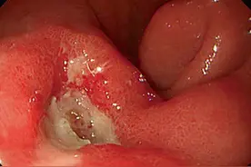 十二指肠溃疡会出现哪些症状？该怎么判断图片