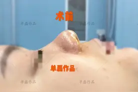 拯救大鼻头（隆鼻案例分享及分析）图片