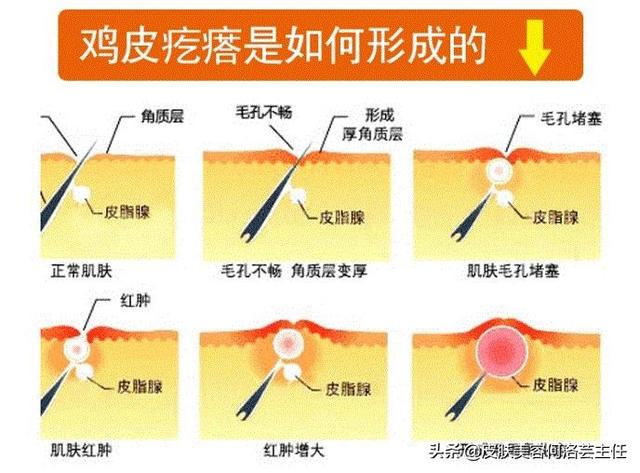 治疗鸡皮疙瘩的方法