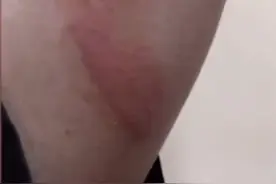 这次又是三星！包中手机突然爆炸起火，男子头发和睫毛被烧焦图片