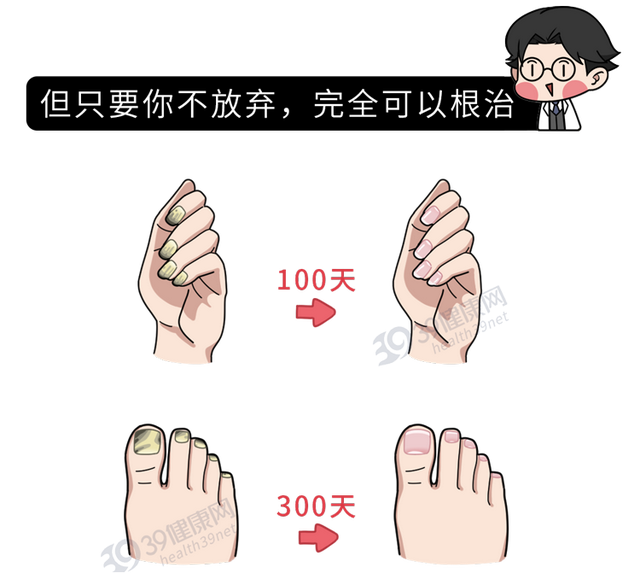得了灰指甲，反复发作难根治？一次性介绍7种药，总有一款适合你