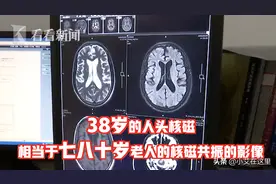 38岁男子因梅毒导致“痴呆晚期”…图片