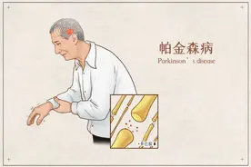 搓丸样震颤、面具脸、路标手……这么多术语您知道是什么意思吗？八个名词带您了解“帕金森”图片