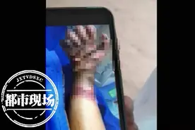 帮帮他吧！江西8岁男童意外触电双手截肢，高昂医药费让全家崩溃图片