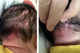 宝宝出现这种红斑，要紧吗？怎么办？图片