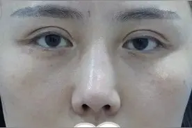 要整容请慎重慎重！我被医美整容失败毁掉的生活图片