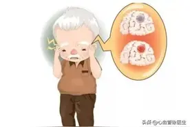 专家提醒：预防脑梗，不能忽视这种心脏疾病“房颤”图片