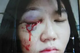女子长期遭丈夫家暴，被拉到墓地殴打眼球破裂，母亲称对方没有打过一次电话了解情况图片