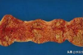 常见又罕见的克罗恩病，极易被误诊为肠胃炎，一旦患上将无法治愈图片