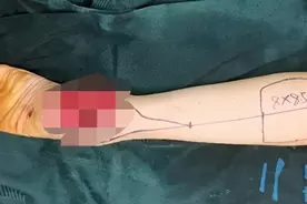 伤口27年没长好，去医院发现是皮肤癌？医生：别把小病拖成大病图片