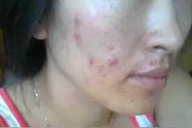 痘痘肌化妆技巧来了！选化妆品要看清成分，上妆手法有窍门图片