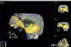 神经磁共振（MRI）系列之脑白质病变-精品图集图片