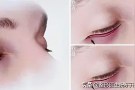 第一次做"外切祛眼袋手术"的人，医生给您一些真实的建议图片