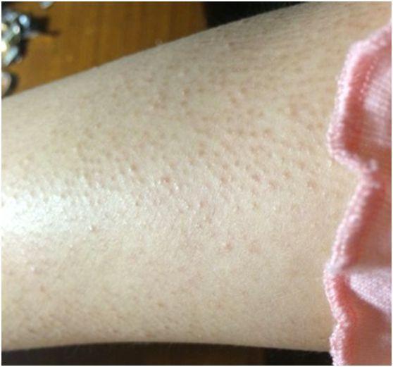 毛周角化症皮肤黑怎么办