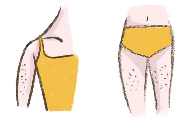 百想膏治鸡皮肤吗 百想膏治鸡皮肤吗