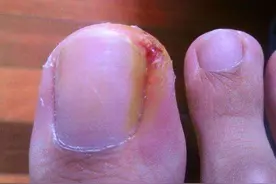 脚趾甲长到肉里，不碰都疼，得了“嵌甲”怎么办？3个办法能缓解图片