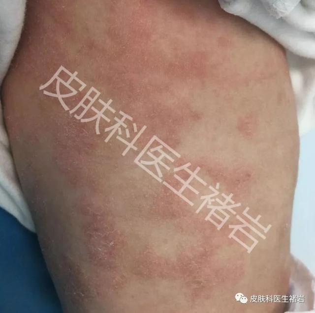 鸡皮疙瘩一块一块红肿