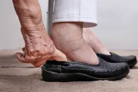 老年人脚肿别忽视，这6种常见的病因，医生逐条给您讲清楚图片