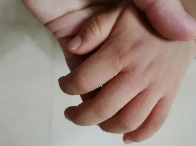 (手心起小疙瘩怎么回事不疼不痒) - 冷求网