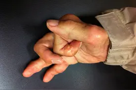 这种让人手脚生石的富贵病，曾经改变了世界的格局图片