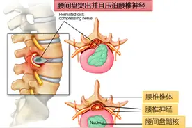 腰椎间盘突出压迫神经了，屁股和腿疼，有什么好的治疗方法？图片