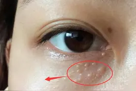 脸上长脂肪粒怎么办？脸上长脂肪粒怎么去除小窍门图片