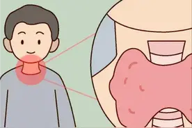 中国第一份甲状腺癌观察报告出炉图片