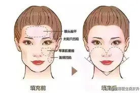 关于"自体脂肪填充面部"，告诉您几个真相图片