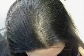 发丝细软塌，发量少还脱发怎么办？我的头发有救了！图片