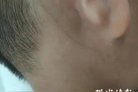 这是什么病？4岁男孩毛发在皮下“游走”，中国报道仅有3例图片