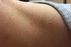 脖子和腋下的“小肉粒”是什么？可以用手直接揪掉吗？建议了解下图片