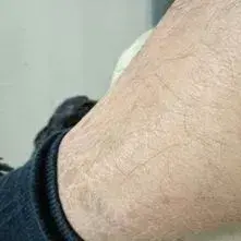 鱼鳞病发病年龄