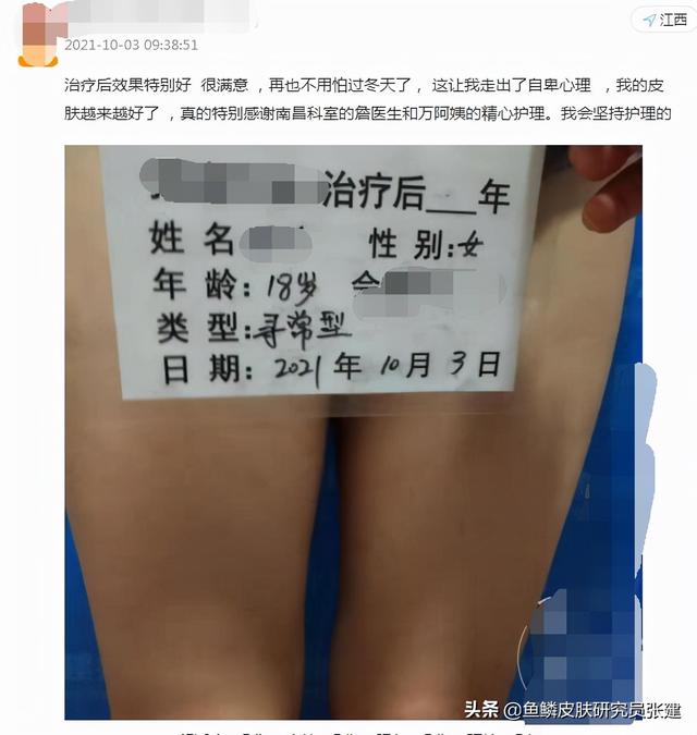 皮肤干燥鱼鳞状小疙瘩