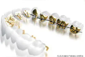 舌侧隐形矫正是怎样的？图片
