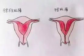 过目难忘！医生手绘畸形子宫图，非常全面，值得收藏图片