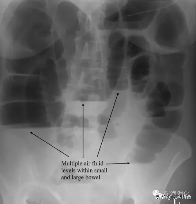 涓撳璇达細鍏充簬鑲犳闃荤殑14涓棶棰? onerror=