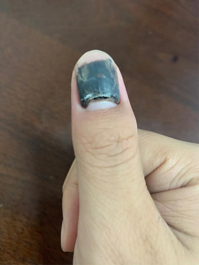 指甲盖被砸了有瘀血怎么办