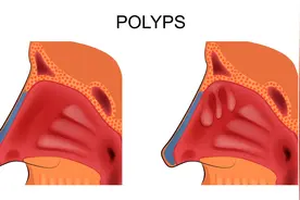 鼻息肉做手术还是药物保守治疗？图片