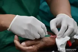 支架术后，你手腕上的创口恢复好了吗？手臂锻炼操来了图片