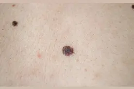 痣变大凸起就一定是要癌变了吗？图片