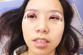 割的双眼皮和天然双眼皮会有什么区别？说出来你不一定会信视频封面
