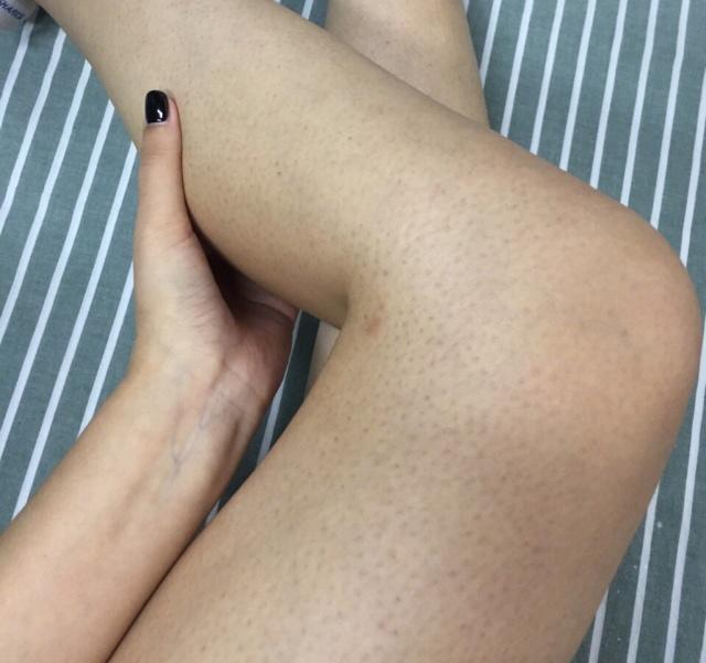 毛周角化可以用果酸身体乳吗