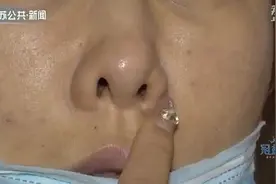 女子隆鼻后鼻子歪了 修复变"大小鼻孔" 施尔美医院退赔！图片