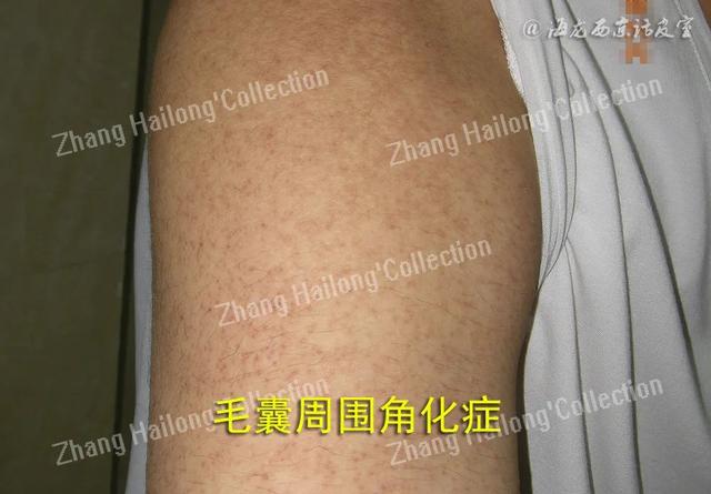 艾滋会引起毛囊角化症