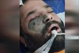 整个人“发霉”而死，可怕疾病蔓延印度图片