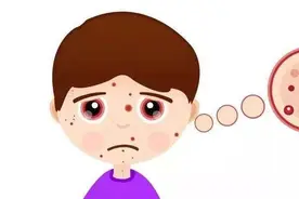 预防和治疗银屑病从忌口开始图片