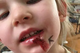 6号染色体缺失，英国女孩变成“三无人类”，睡觉都需要安眠药图片