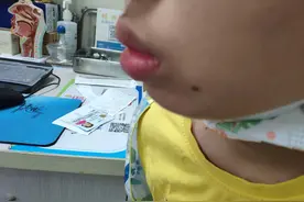 得了腺样体面容，越长越丑，已经十八岁了，我该如何早点发现？图片